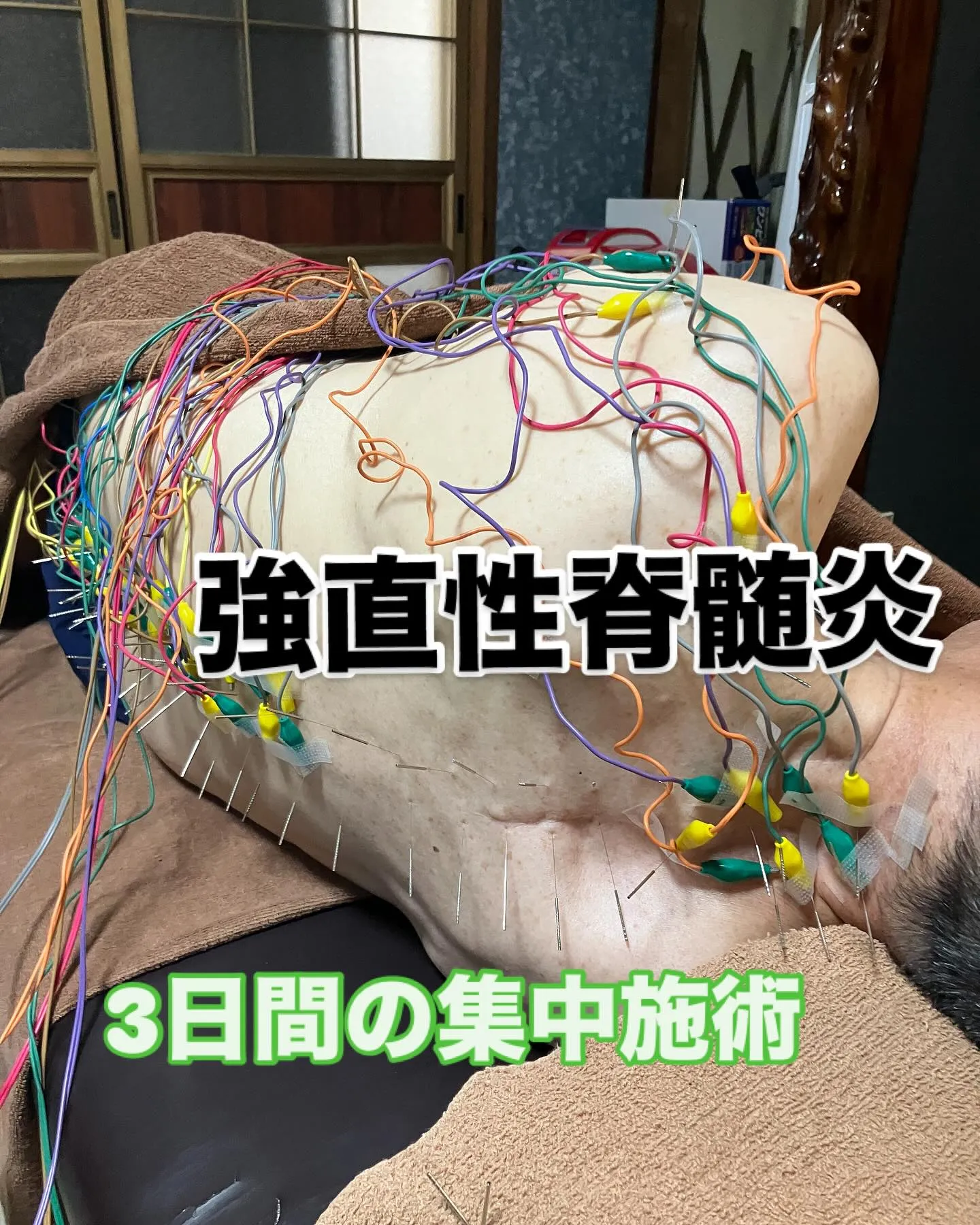 強直性脊髄炎の施術風景〜
