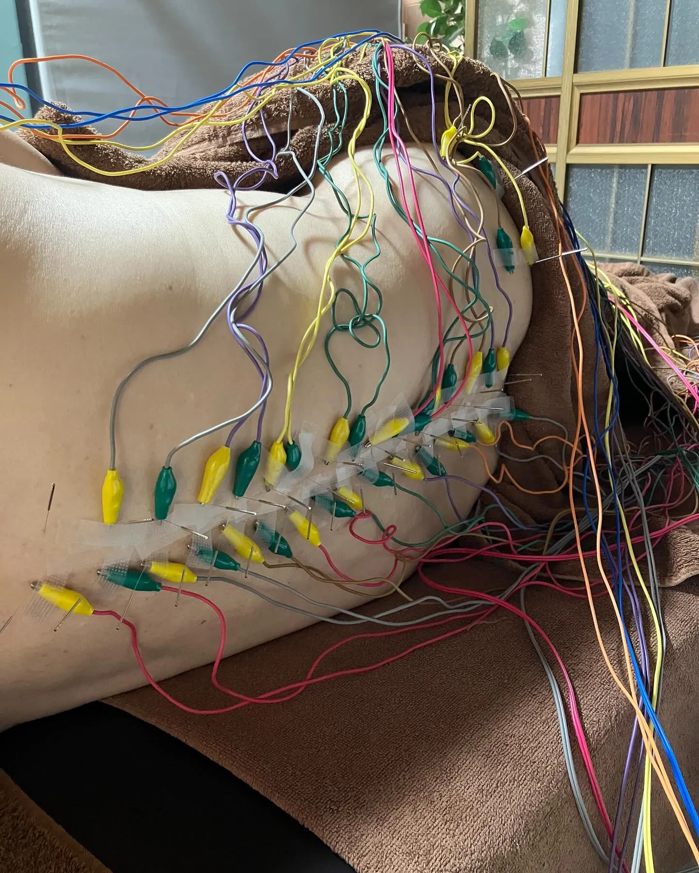 強直性脊髄炎の施術風景〜