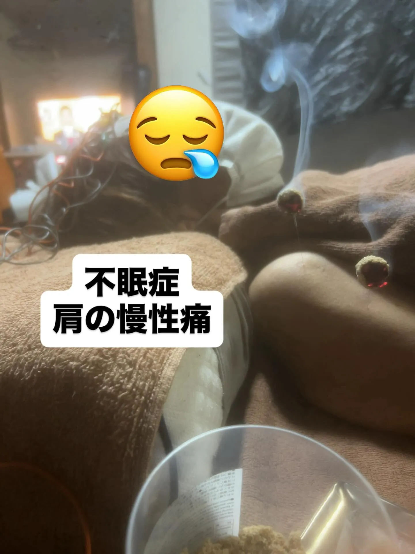 不眠症-肩の慢性痛に対して鍼灸施術