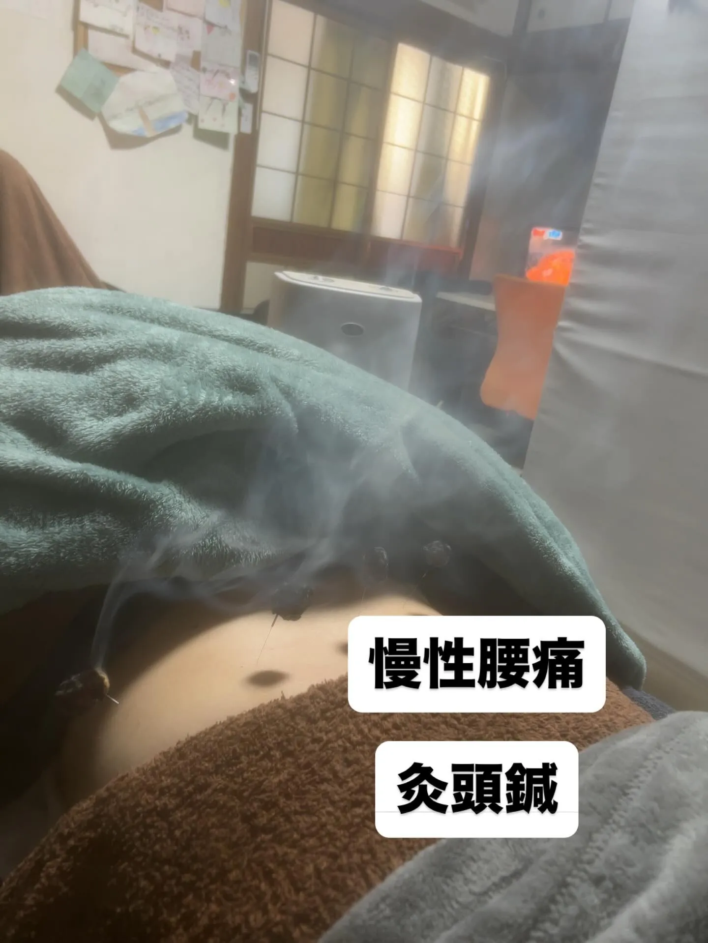 慢性腰痛にはお灸📣