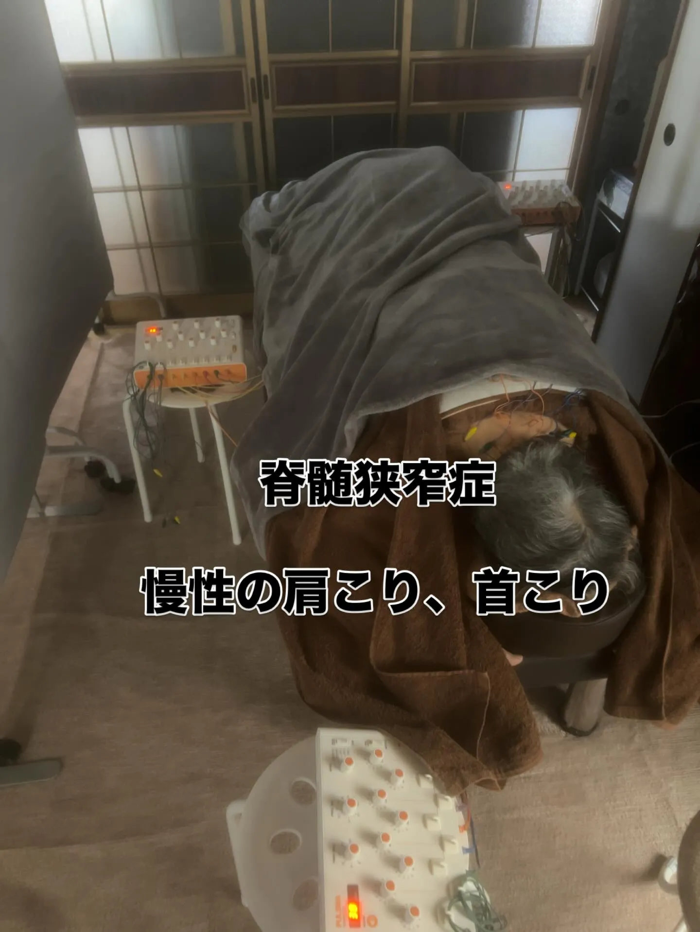 脊髄狭窄症、肩こりに対する鍼灸施術