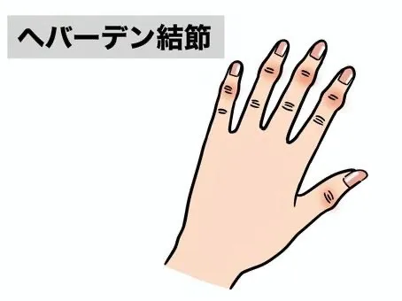 令和８年　NEW　へバーデン結節（指の痛み・変形）