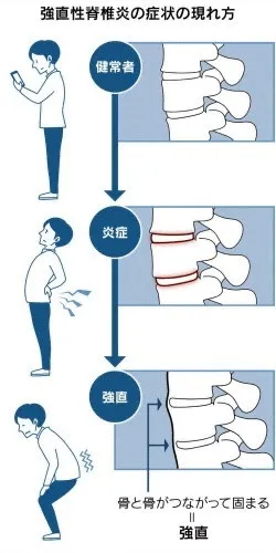 令和８年　NEW　  強直性脊髄炎・腰痛