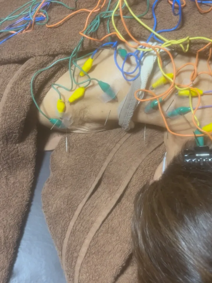 慢性の肩こり、五十肩、保険適応